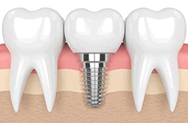 Implante dentário, Dra Lauciana Maribondo-medicosrio.com.br