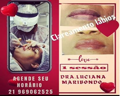 Clareamento dos dentes, após análise, com Dra Luciana Maribondo - DentistasRio