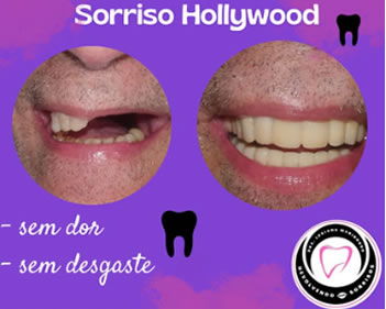 Sorriso dos Artitas. Sem cirugia, sem anestesia, Dra Luciana Maribondo - DentistasRio