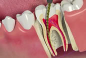 Tratamento de Canal - Endodontia